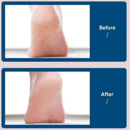 Electric Foot File | Remove Dead Skin & Calluses with Ease
